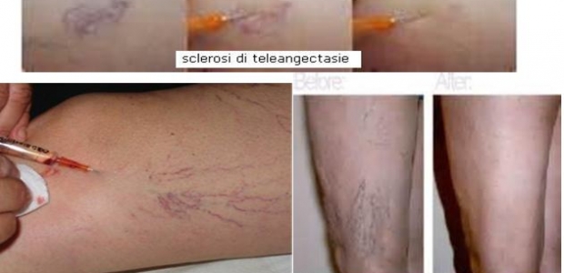 scleroterapia milano forum)
